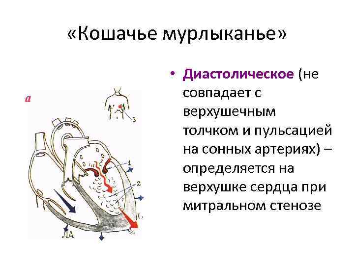  «Кошачье мурлыканье» • Диастолическое (не совпадает с верхушечным толчком и пульсацией на сонных