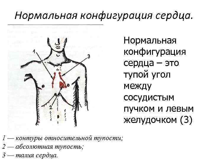 Нормальная конфигурация сердца – это тупой угол между сосудистым пучком и левым желудочком (3)