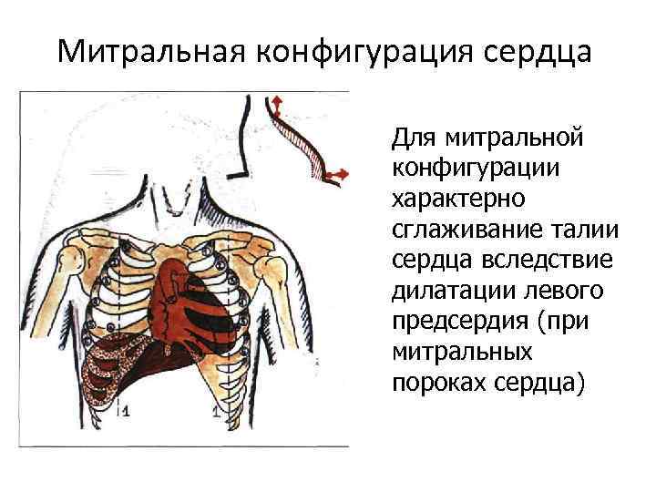 Митральная конфигурация сердца Для митральной конфигурации характерно сглаживание талии сердца вследствие дилатации левого предсердия