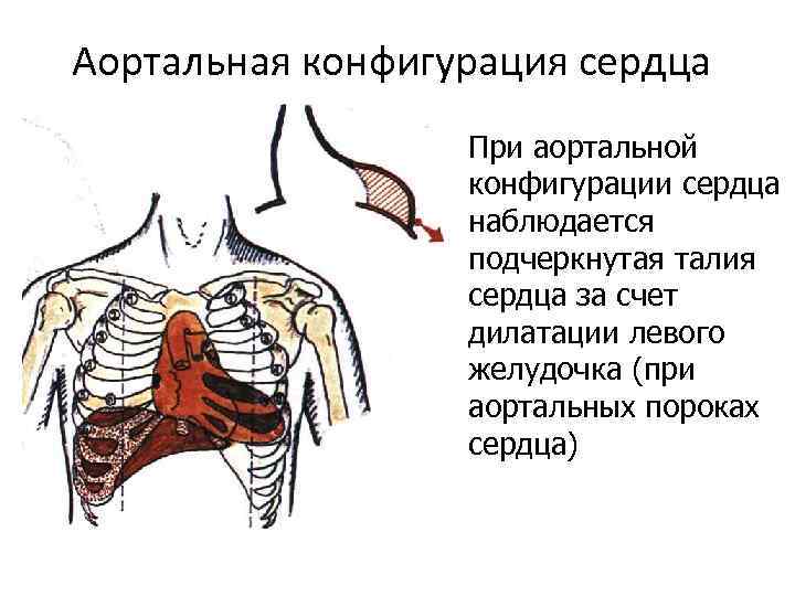 Аортальная конфигурация сердца При аортальной конфигурации сердца наблюдается подчеркнутая талия сердца за счет дилатации