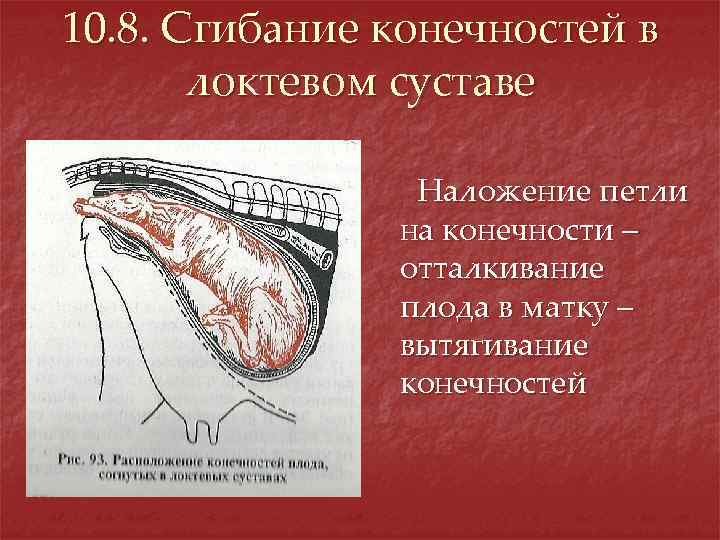 10. 8. Сгибание конечностей в локтевом суставе Наложение петли на конечности – отталкивание плода