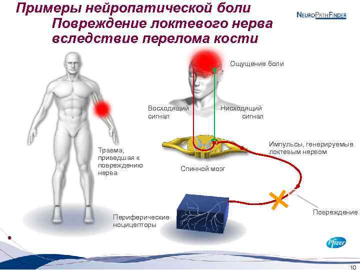 Примеры нейропатической боли Повреждение локтевого нерва вследствие перелома кости Ощущение боли Восходящий сигнал Травма,