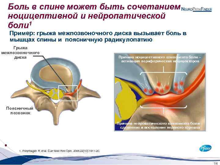 Боль в спине может быть сочетанием ноцицептивной и нейропатической боли 1 Пример: грыжа межпозвоночного