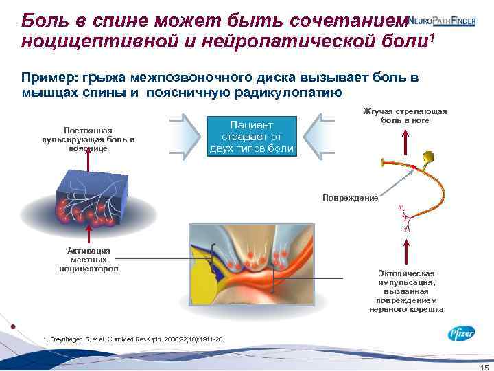 Боль в спине может быть сочетанием ноцицептивной и нейропатической боли 1 Пример: грыжа межпозвоночного