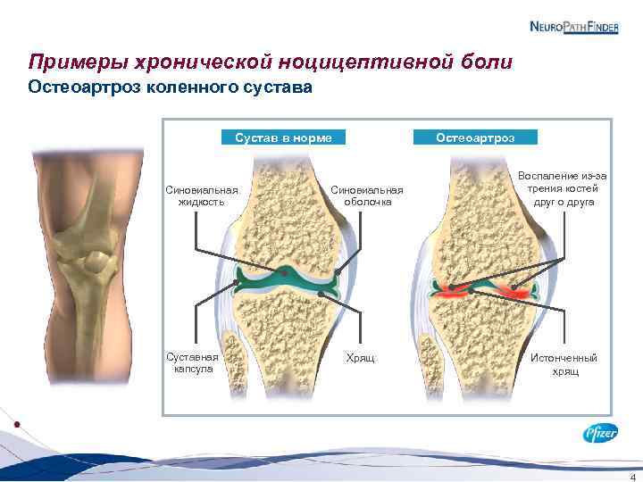 Примеры хронической ноцицептивной боли Остеоартроз коленного сустава Сустав в норме Синовиальная жидкость Суставная капсула