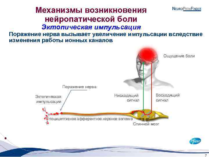 Механизмы возникновения нейропатической боли Эктопическая импульсация Поражение нерва вызывает увеличение импульсации вследствие изменения работы