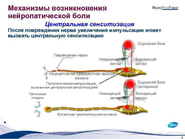 Механизмы возникновения нейропатической боли Центральная сенситизация После повреждения нерва увеличение импульсации может вызвать центральную