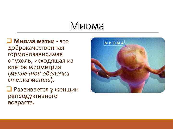 Миома q Миома матки - это доброкачественная гормонозависимая опухоль, исходящая из клеток миометрия (мышечной