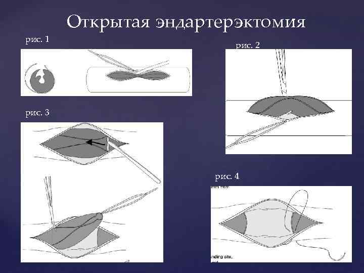 рис. 1 Открытая эндартерэктомия рис. 2 рис. 3 рис. 4 