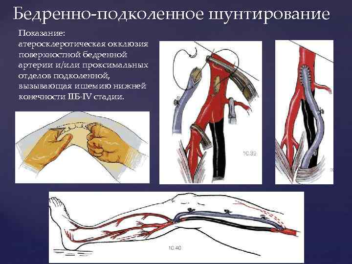 Бедренно-подколенное шунтирование Показание: атеросклеротическая окклюзия поверхностной бедренной артерии и/или проксимальных отделов подколенной, вызывающая ишемию