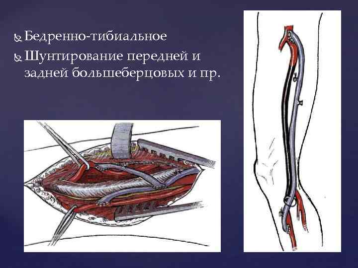 Бедренно-тибиальное Шунтирование передней и задней большеберцовых и пр. 