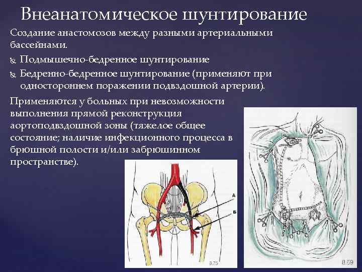 Внеанатомическое шунтирование Создание анастомозов между разными артериальными бассейнами. Подмышечно-бедренное шунтирование Бедренно-бедренное шунтирование (применяют при