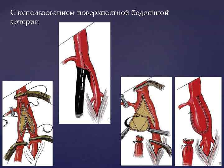 С использованием поверхностной бедренной артерии 