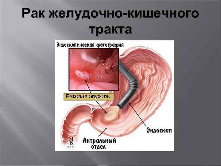 Рак желудочно-кишечного тракта Раковая опухоль 