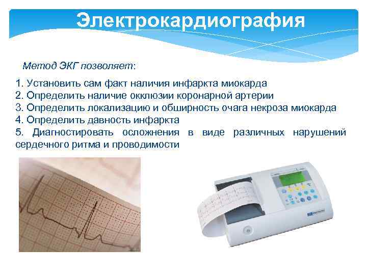 Электрокардиография Метод ЭКГ позволяет: 1. Установить сам факт наличия инфаркта миокарда 2. Определить наличие