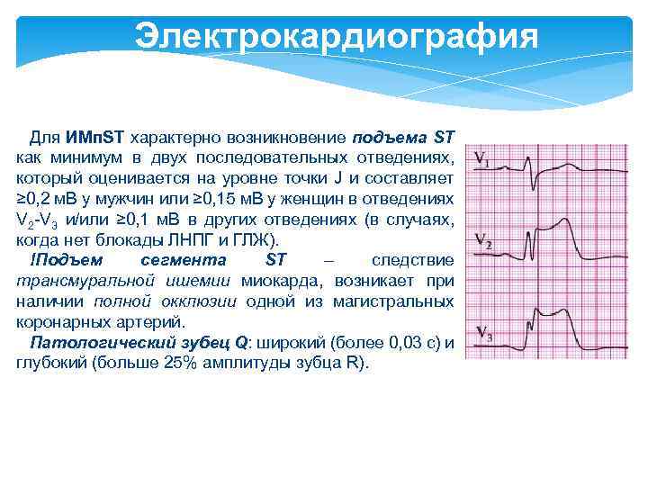 Электрокардиография Для ИМп. ST характерно возникновение подъема ST как минимум в двух последовательных отведениях,