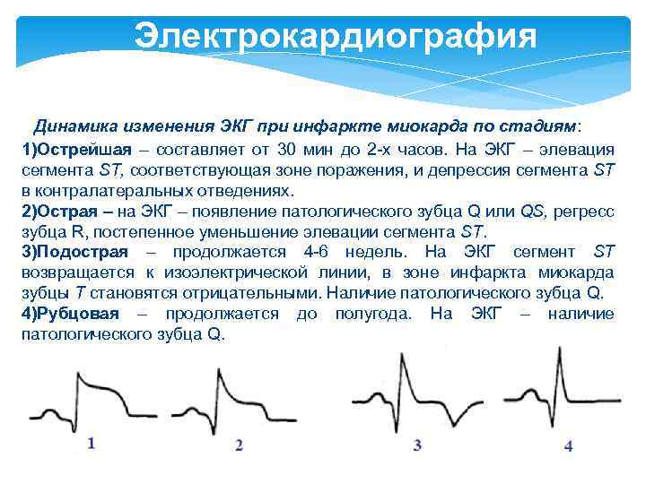 Электрокардиография Динамика изменения ЭКГ при инфаркте миокарда по стадиям: 1)Острейшая – составляет от 30