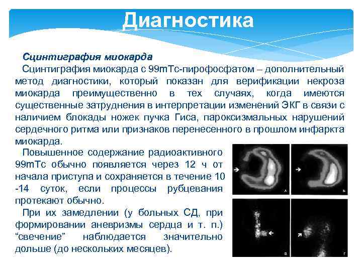 Диагностика Сцинтиграфия миокарда с 99 m. Tc-пирофосфатом – дополнительный метод диагностики, который показан для