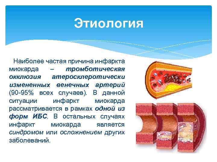 Этиология Наиболее частая причина инфаркта миокарда – тромботическая окклюзия атеросклеротически измененных венечных артерий (90