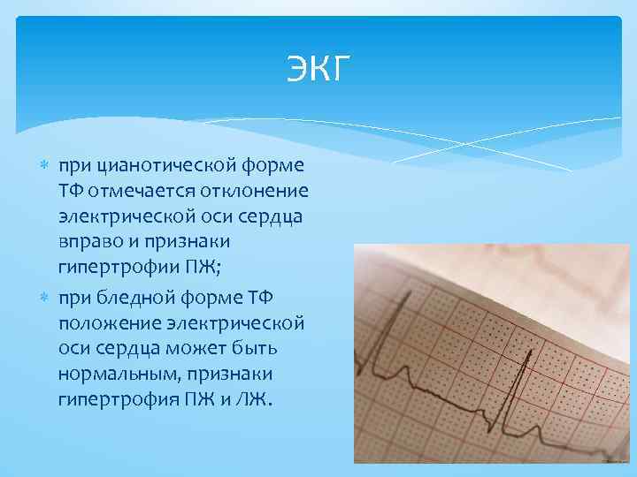 ЭКГ при цианотической форме ТФ отмечается отклонение электрической оси сердца вправо и признаки гипертрофии