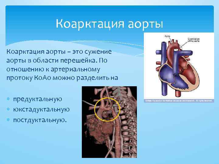 Коарктация аорты фото