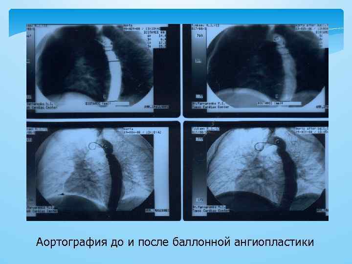 Аортография до и после баллонной ангиопластики 
