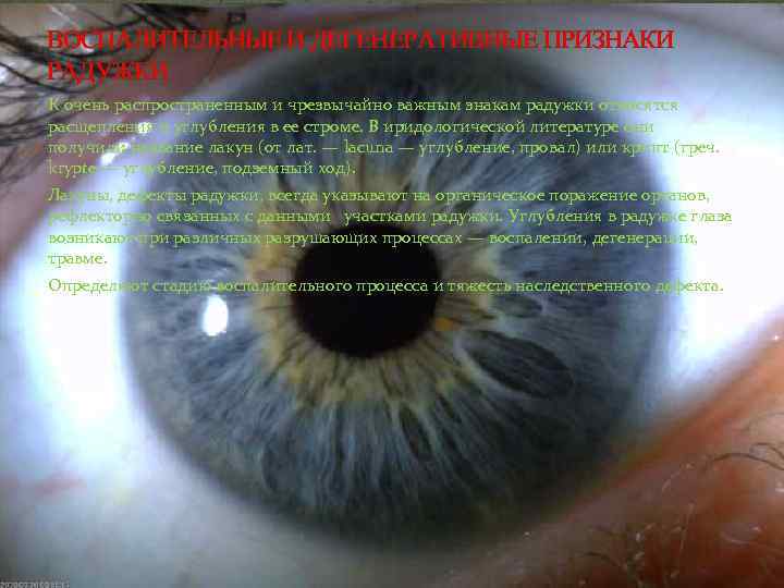 ВОСПАЛИТЕЛЬНЫЕ И ДЕГЕНЕРАТИВНЫЕ ПРИЗНАКИ РАДУЖКИ К очень распространенным и чрезвычайно важным знакам радужки относятся