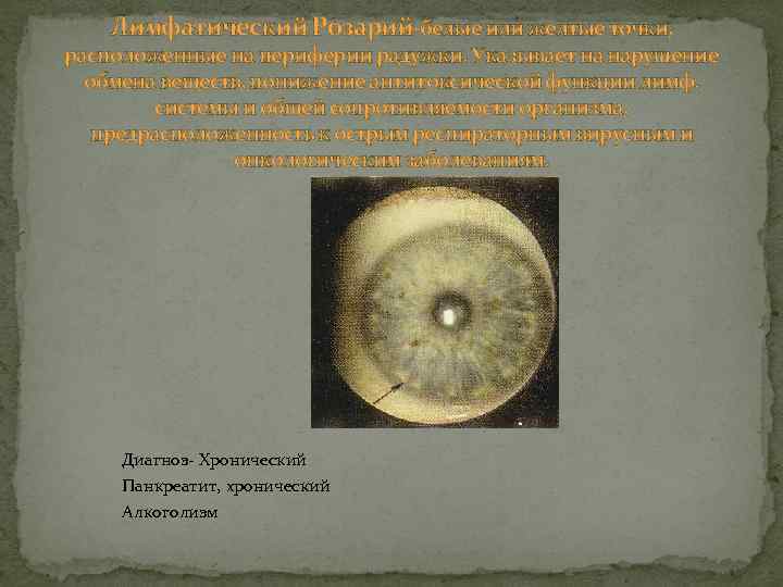 Лимфатический Розарий-белые или желтые точки, расположенные на периферии радужки. Указывает на нарушение обмена веществ,