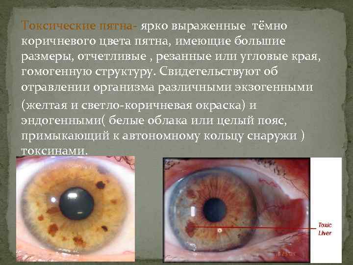 Токсические пятна ярко выраженные тёмно коричневого цвета пятна, имеющие большие размеры, отчетливые , резанные