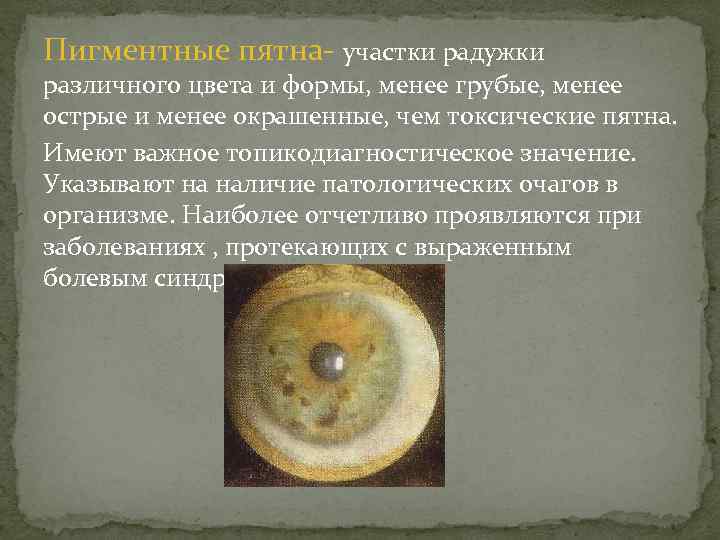 Пигментные пятна участки радужки различного цвета и формы, менее грубые, менее острые и менее