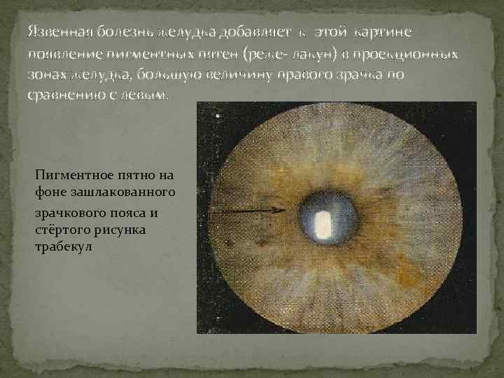 Язвенная болезнь желудка добавляет к этой картине появление пигментных пятен (реже лакун) в проекционных