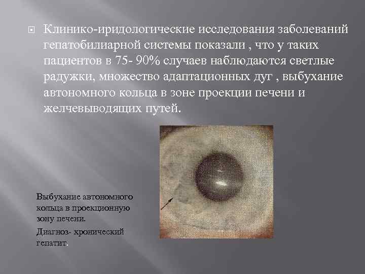  Клинико иридологические исследования заболеваний гепатобилиарной системы показали , что у таких пациентов в