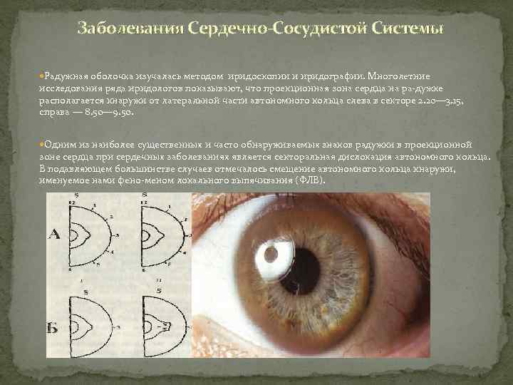 Заболевания Сердечно-Сосудистой Системы Радужная оболочка изучалась методом иридоскопии и иридографии. Многолетние исследования ряда иридологов