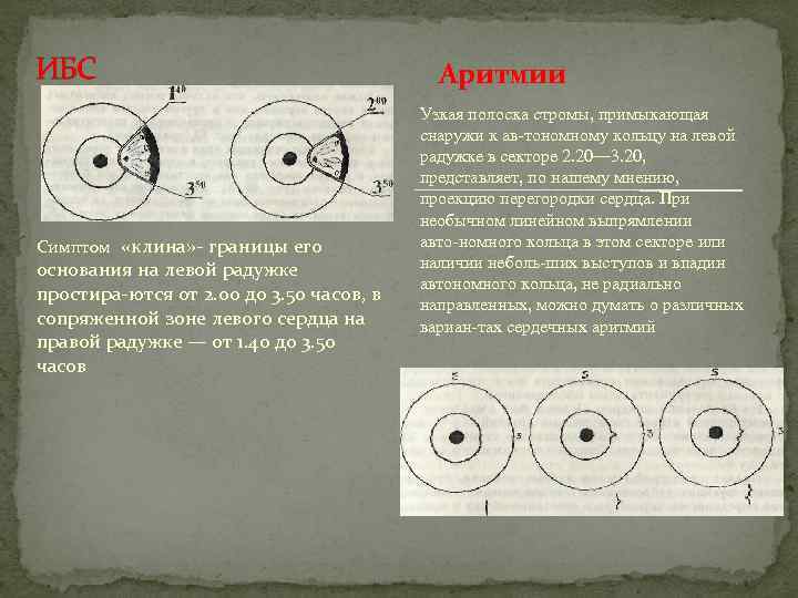 ИБС Симптом «клина» границы его основания на левой радужке простира ются от 2. 00