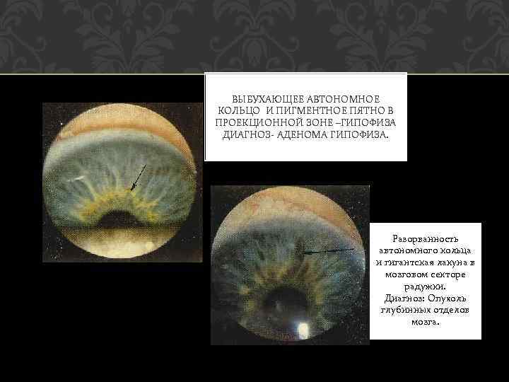ВЫБУХАЮЩЕЕ АВТОНОМНОЕ КОЛЬЦО И ПИГМЕНТНОЕ ПЯТНО В ПРОЕКЦИОННОЙ ЗОНЕ –ГИПОФИЗА ДИАГНОЗ АДЕНОМА ГИПОФИЗА. Разорванность