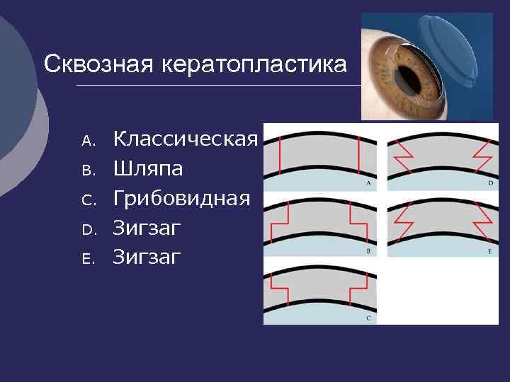 Сквозная кератопластика A. B. C. D. E. Классическая Шляпа Грибовидная Зигзаг 