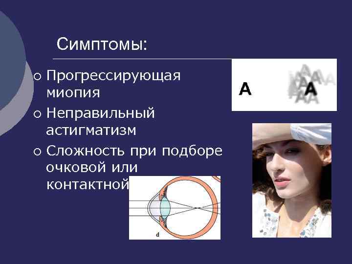 Симптомы: Прогрессирующая миопия ¡ Неправильный астигматизм ¡ Сложность при подборе очковой или контактной коррекции