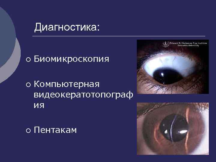 Диагностика: ¡ ¡ ¡ Биомикроскопия Компьютерная видеокератотопограф ия Пентакам 