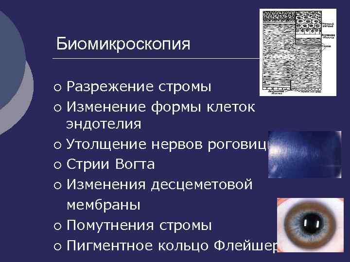 Биомикроскопия Разрежение стромы ¡ Изменение формы клеток эндотелия ¡ Утолщение нервов роговицы ¡ Стрии