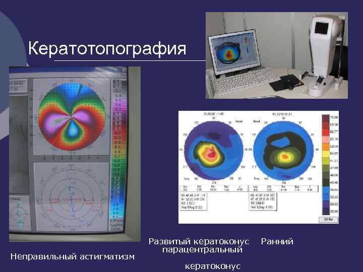 Кератотопография Неправильный астигматизм Развитый кератоконус Ранний парацентральный кератоконус 