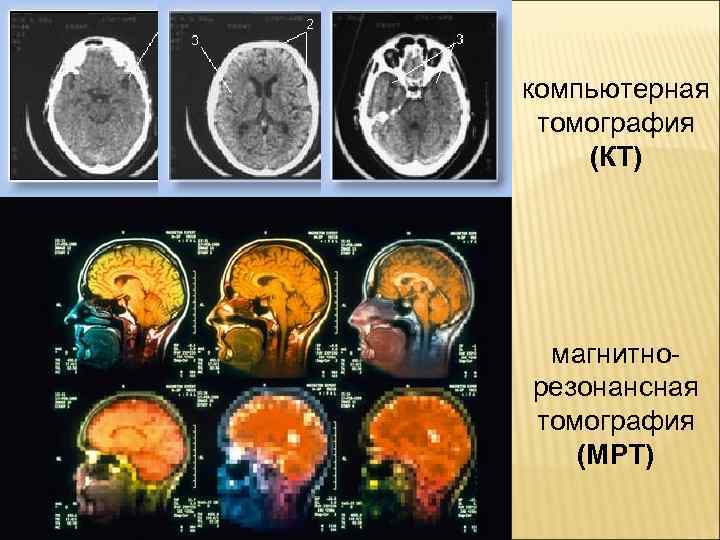 Болезнь альцгеймера картина мрт