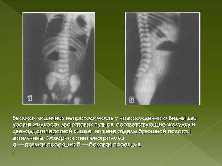 Врожденная кишечная. Высокая кишечная непроходимость у детей рентген. Врожденная кишечная непроходимость рентген. Врожденная высокая кишечная непроходимость рентген. Врожденная кишечная непроходимость рентгенография.