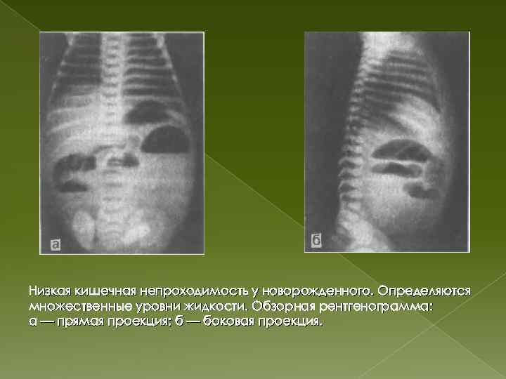 Низкая кишечная непроходимость у новорожденного. Определяются множественные уровни жидкости. Обзорная рентгенограмма: а — прямая