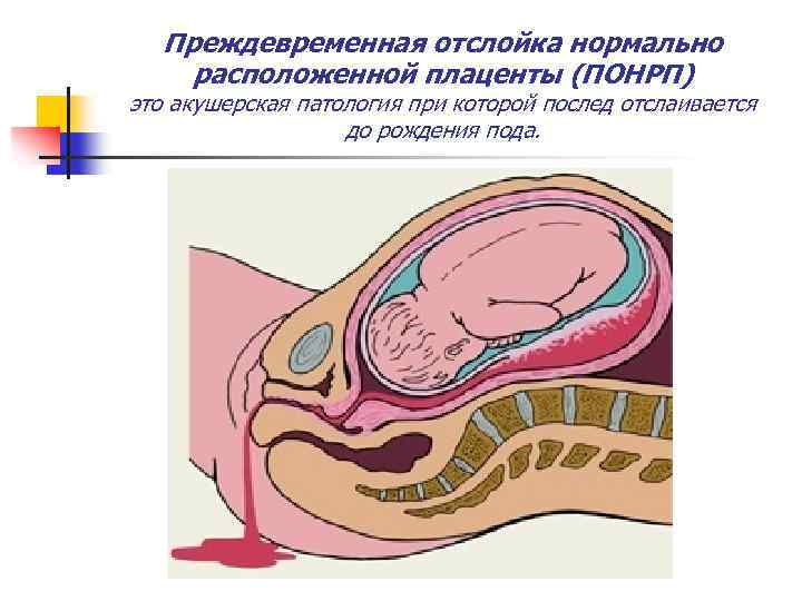 Преждевременная отслойка нормально расположенной плаценты (ПОНРП) это акушерская патология при которой послед отслаивается до