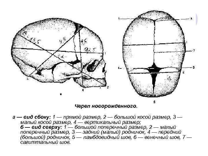  Череп новорожденного. а — вид сбоку: 1 — прямой размер, 2 — большой
