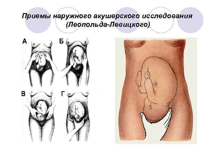 Приемы наружного акушерского исследования (Леопольда-Левицкого) 