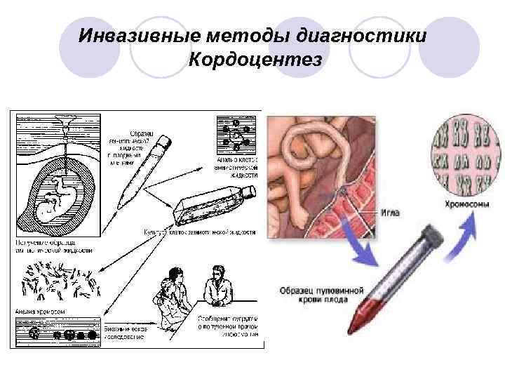 Инвазивные методы диагностики Кордоцентез 