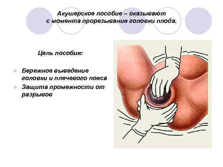 Акушерское пособие – оказывают с момента прорезывания головки плода. Цель пособия: Бережное выведение головки