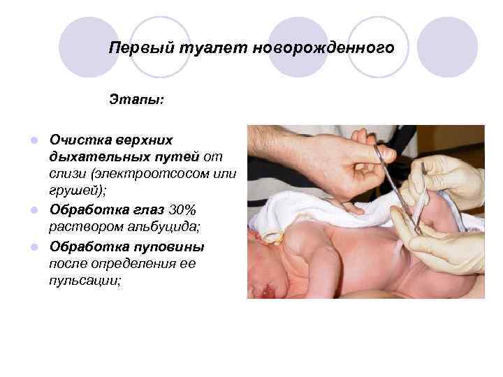 Первый туалет новорожденного Этапы: Очистка верхних дыхательных путей от слизи (электроотсосом или грушей); l