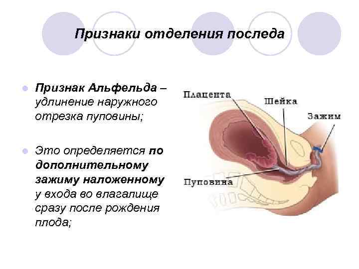 Признаки отделения последа l Признак Альфельда – удлинение наружного отрезка пуповины; l Это определяется